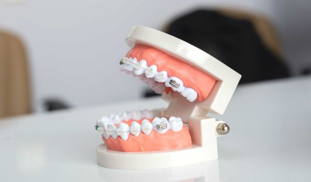 blog post orthodontic braces types costs and pros and cons 9e2344ec