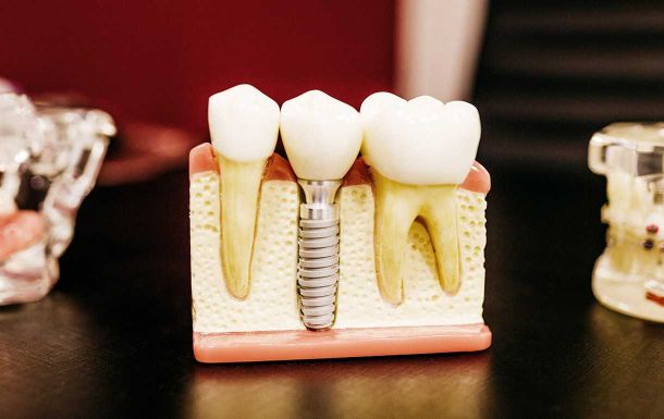 services dental implants procedure 03 730a9472