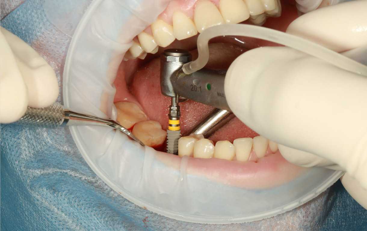services dental implants procedure 02
